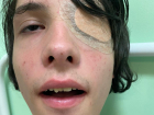 В Краснодаре школьник разбил голову и глаз однокласснику