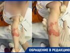 Ожог второй степени: кастрюлю с кипящим супом опрокинул на себя малыш в детском саду Краснодара