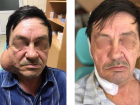  Краснодарские врачи удалили огромную опухоль с лица мужчины 