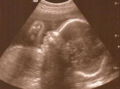 В Адыгее  мать привела к гинекологу 12-летнюю на седьмом месяце беременности