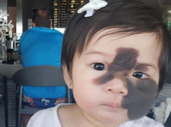 Вторая малышка из США прилетит в Краснодар для удаления гигантского черного пятна с лица