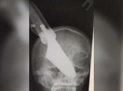 Кубанские медики извлекли 25-сантиметровый нож из головы 60-летней женщины