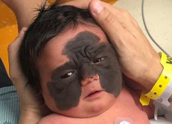 Краснодарский врач решил помочь девочке с «маской Бэтмена» из США