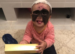 Краснодарские врачи поделились первыми результатами лечения девочки с «маской Бэтмена»