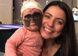 Неизвестный россиянин оплатил лечение девочки с «маской Бэтмена» в Краснодаре 