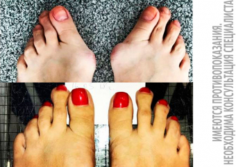 Честные ответы авторитетного хирурга о шишках на ногах