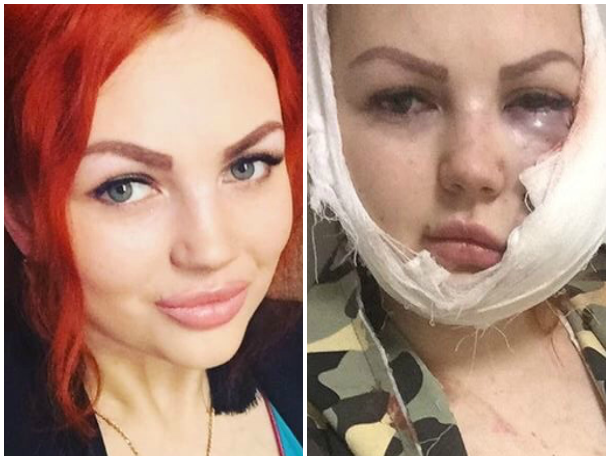 Поход в караоке для жительницы Апшеронска закончился сотрясением головного мозга и порезами на лице