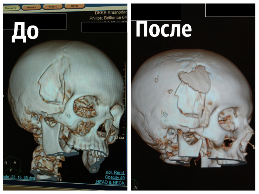 Кубанские нейрохирурги совершили чудо в канун Нового года и вернули к жизни ребенка