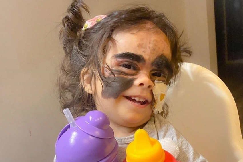 Сложный этап: девочке с маской «Бэтмена» проведут более длинную и деликатную операцию