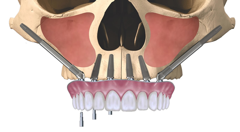1zygomatic-upper-teeth.jpg